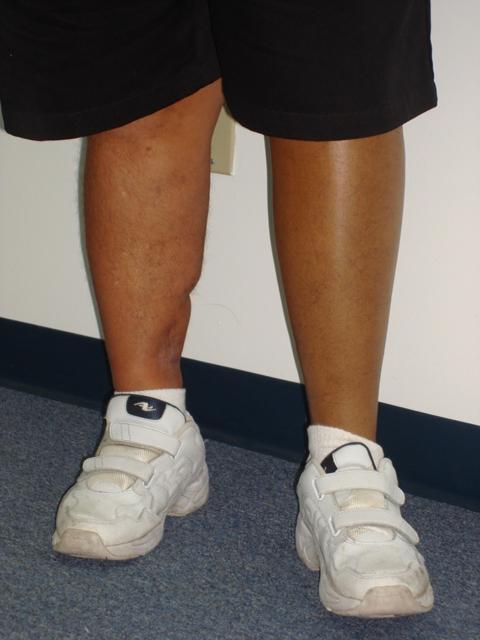 Comparison of two legs showing different skin tones and conditions.